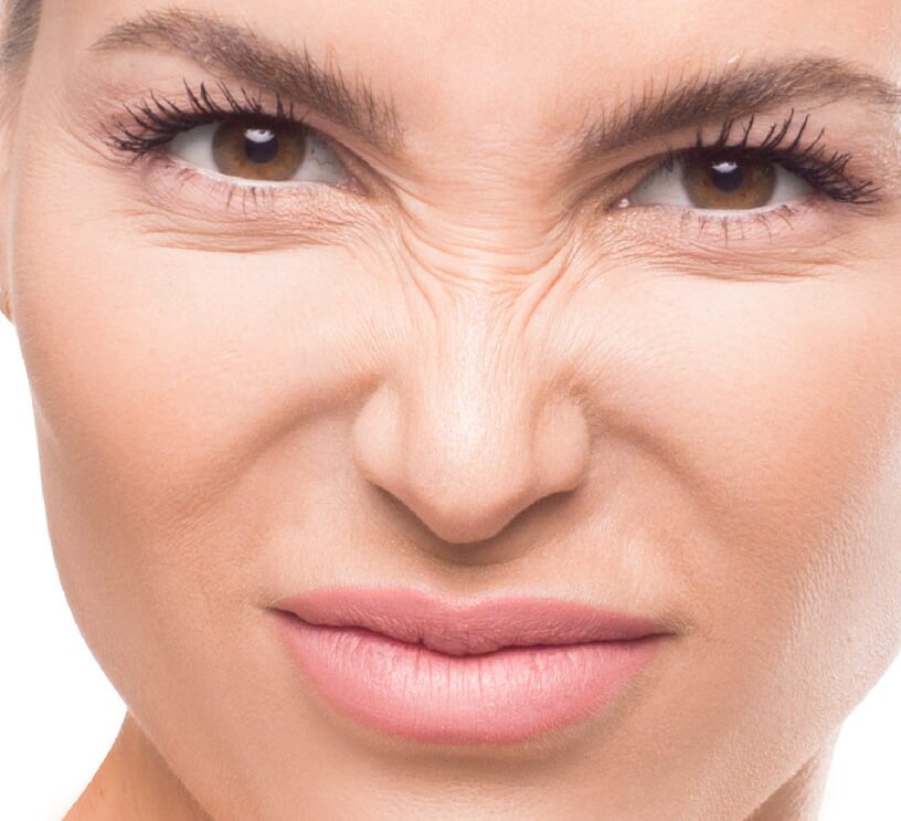 bunny lines on female nose