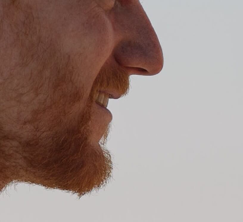 droopy nasal tip