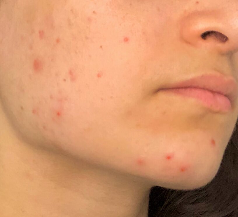 acne on female face