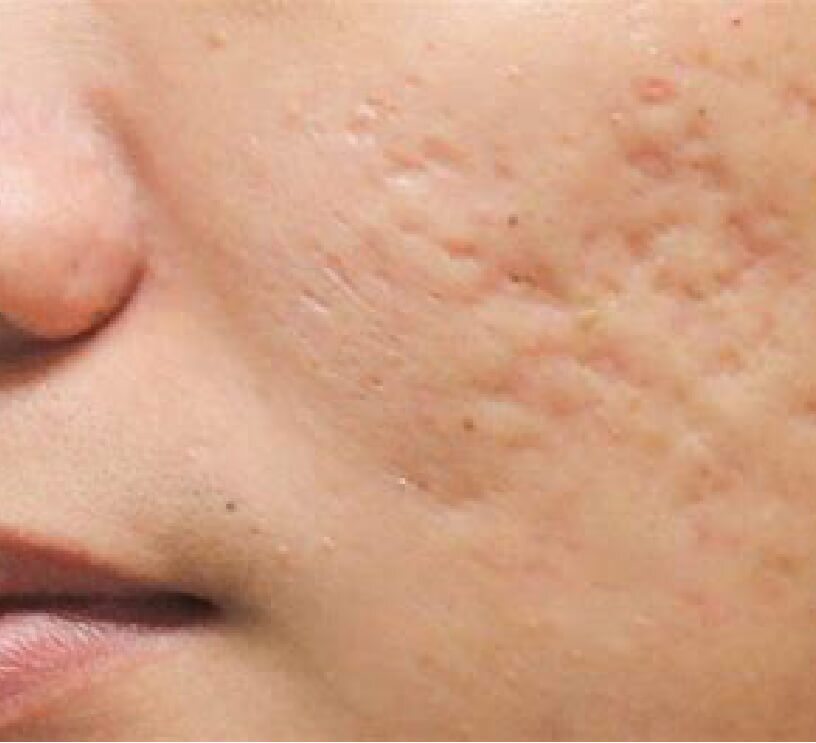 acne scars on face