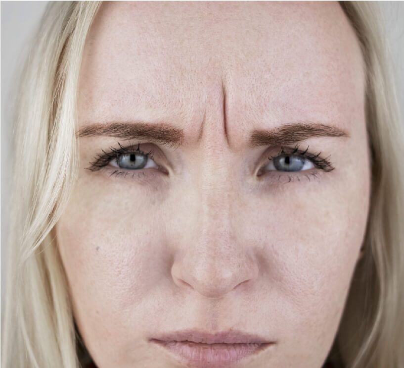 frown lines
