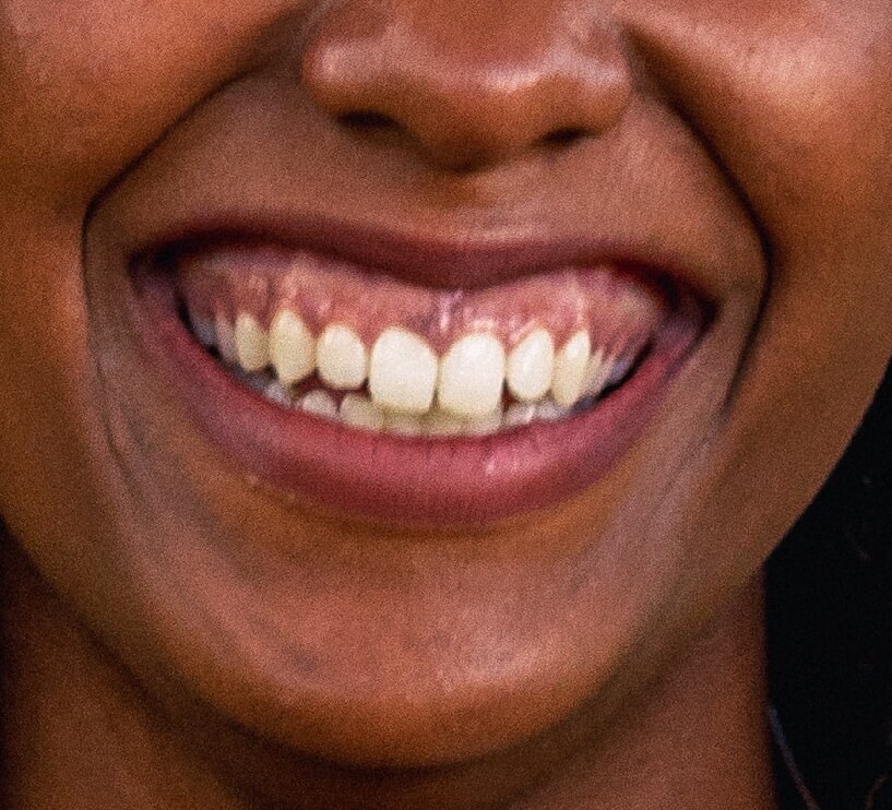 gummy smile