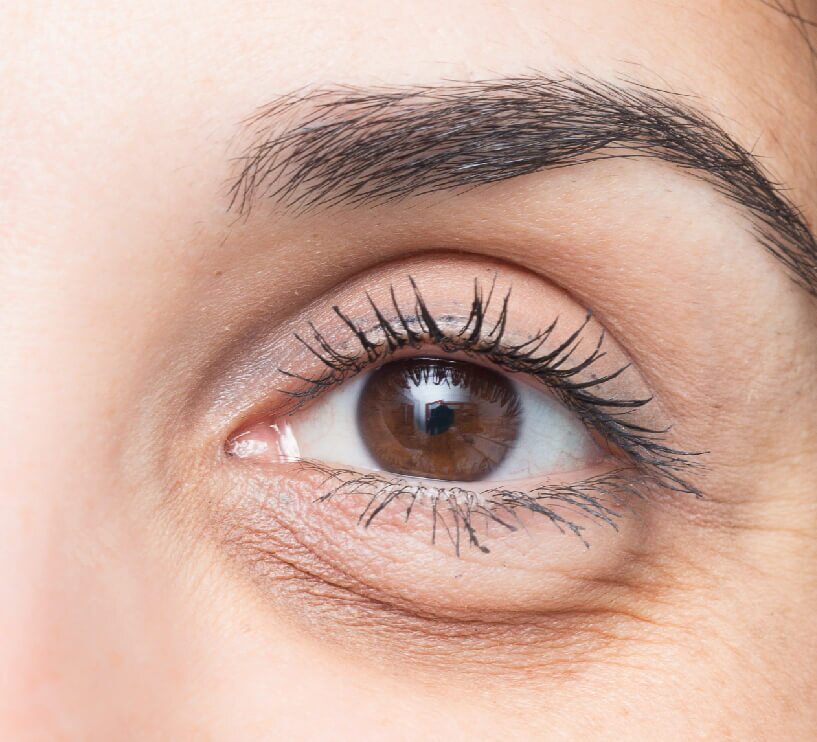 sagging lower eyelids