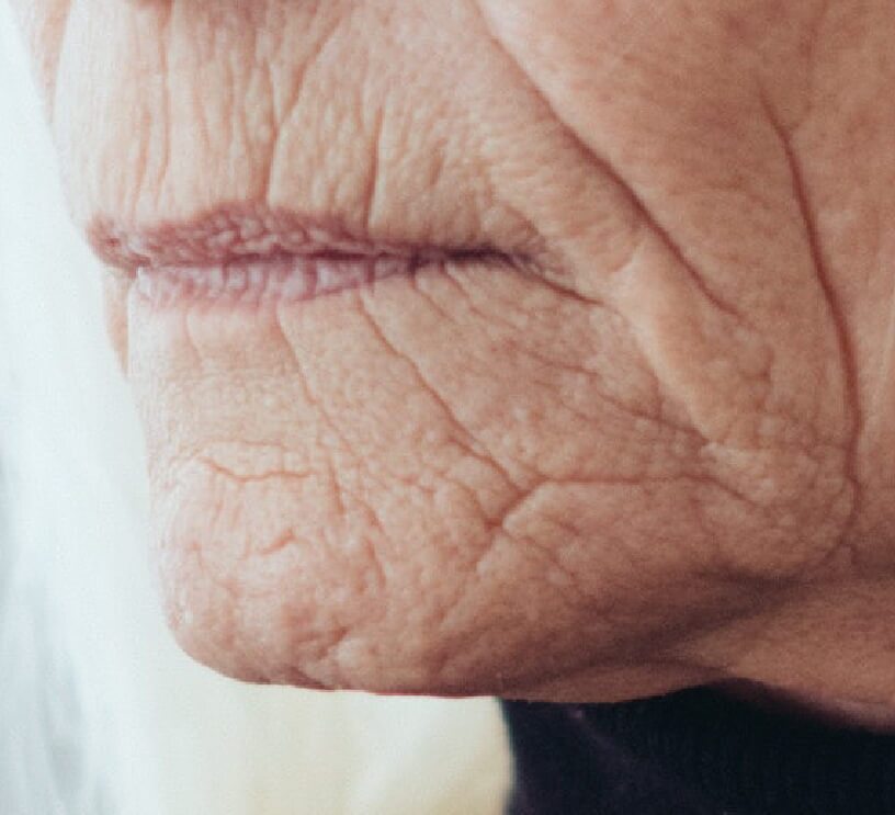 smoker's lines around lips