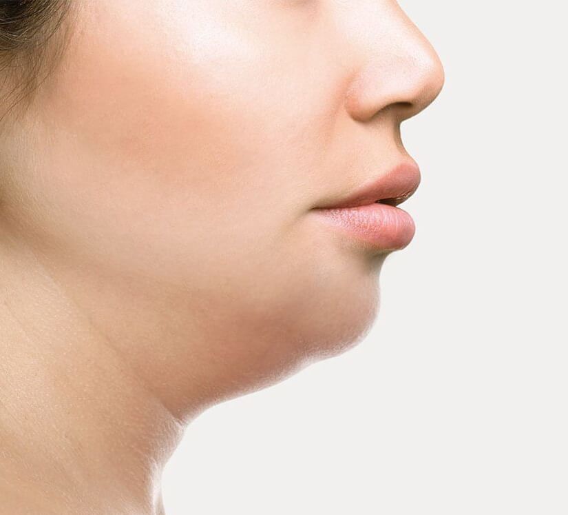 double chin