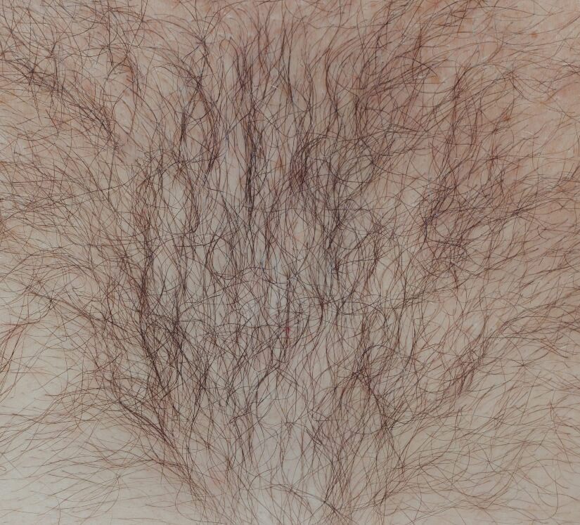 excess hair