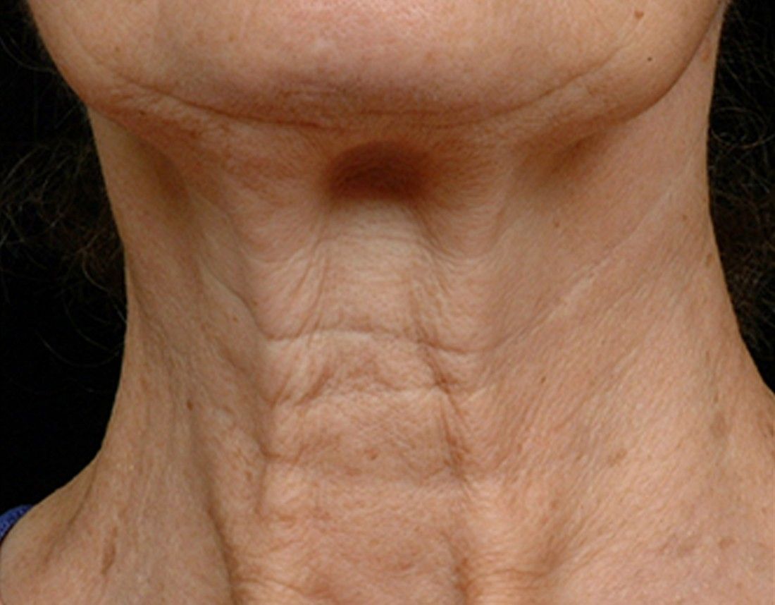 wrinkly neck and neck lines