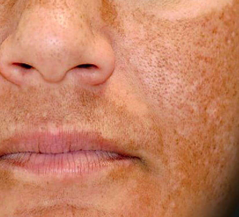 poor skin complexion