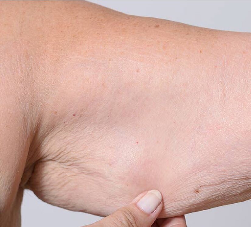 sagging upper arm skin