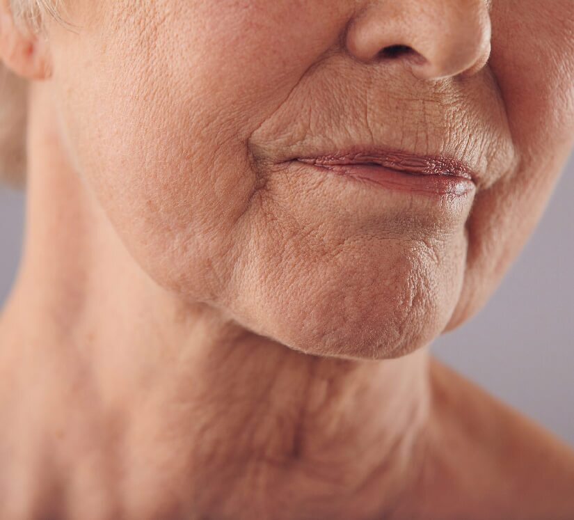wrinkly skin on face