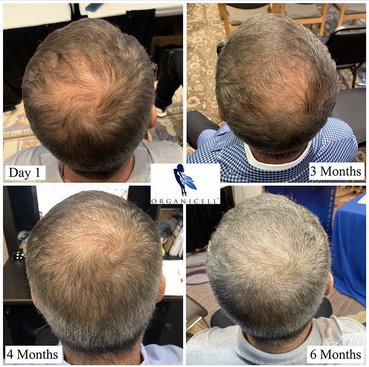 prp injections