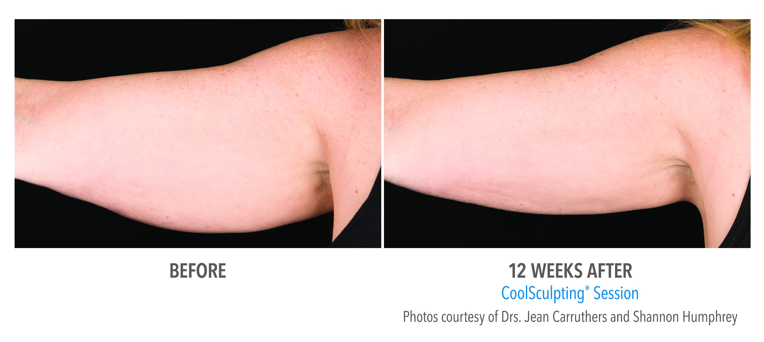 CoolSculpting arm fat