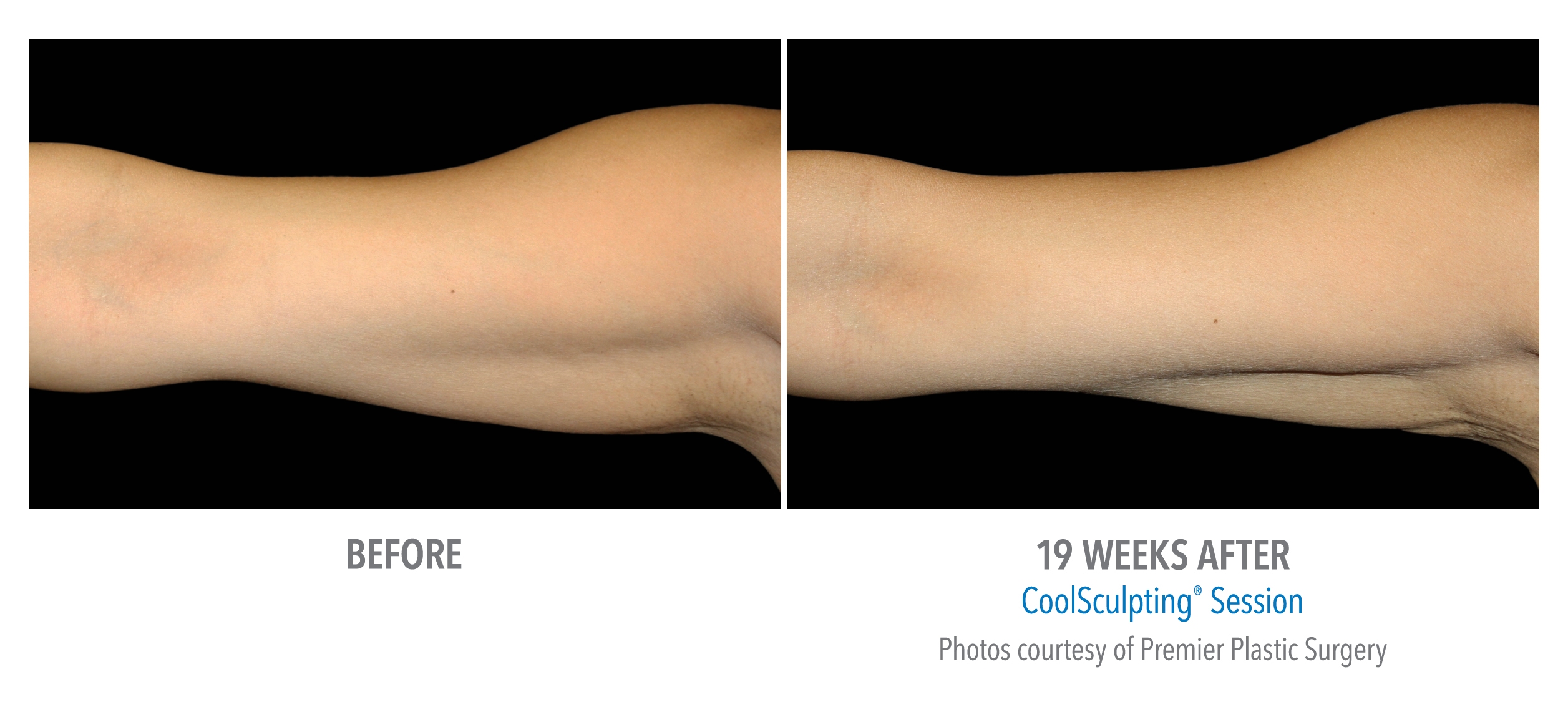 arm fat coolsculpting