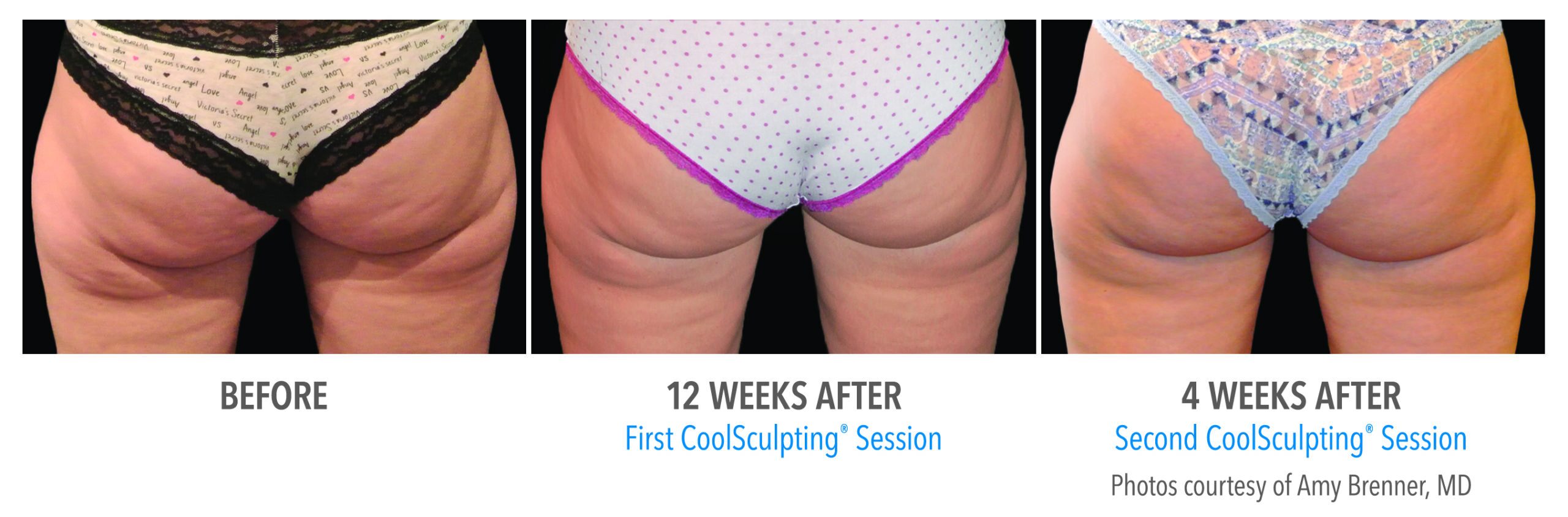 banana roll coolsculpting