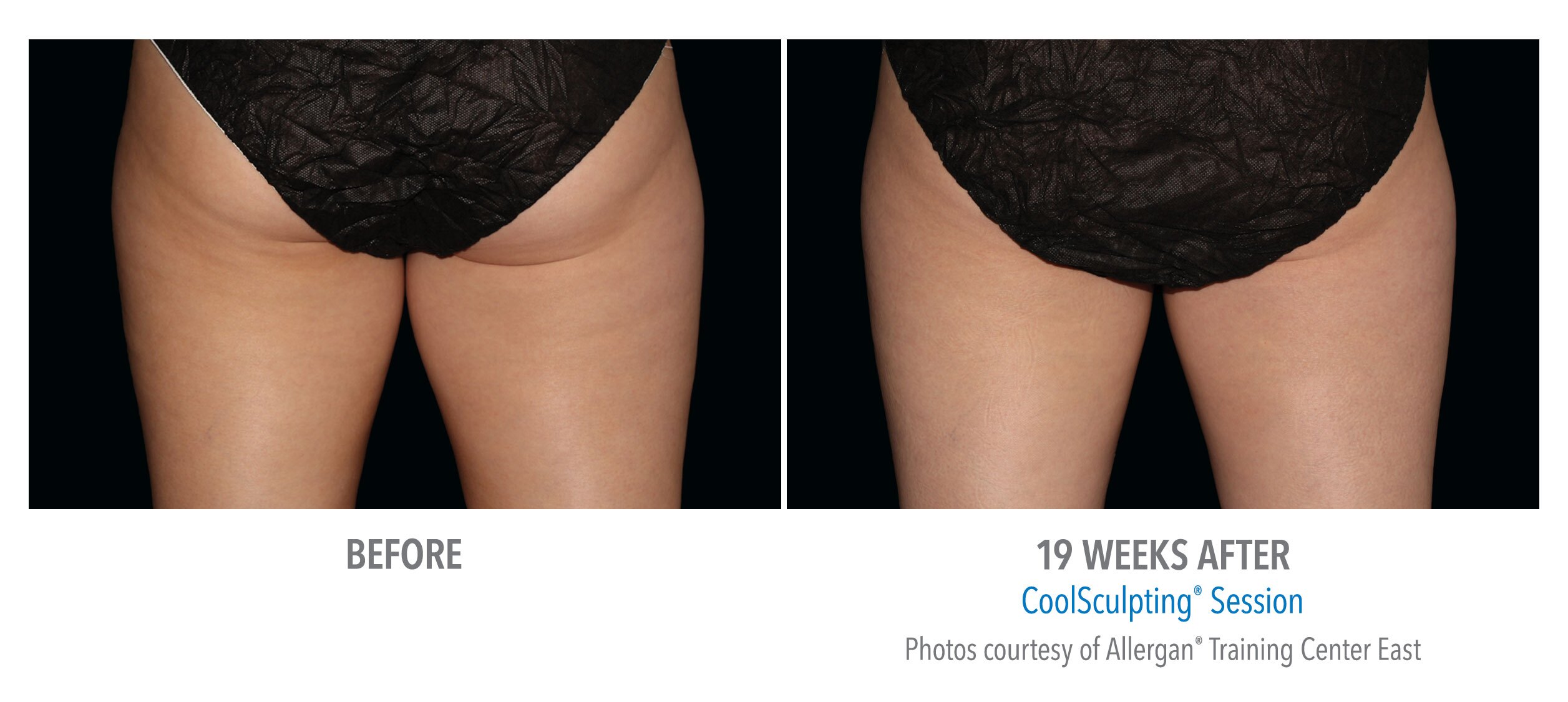 cellulite removal coolsculpting
