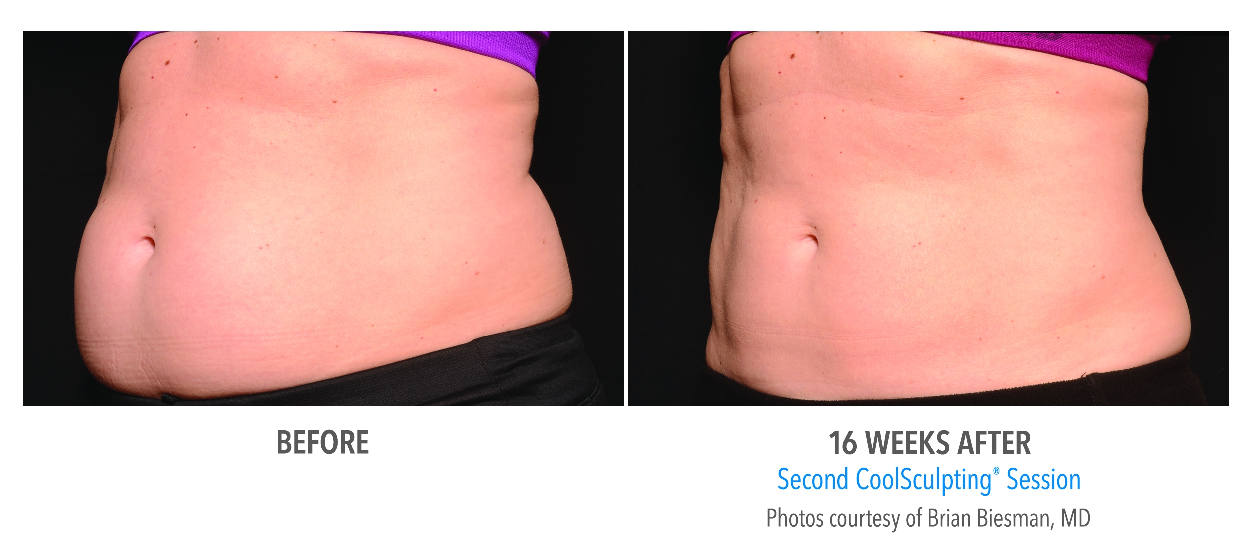 coolsculpting abdomen san diego
