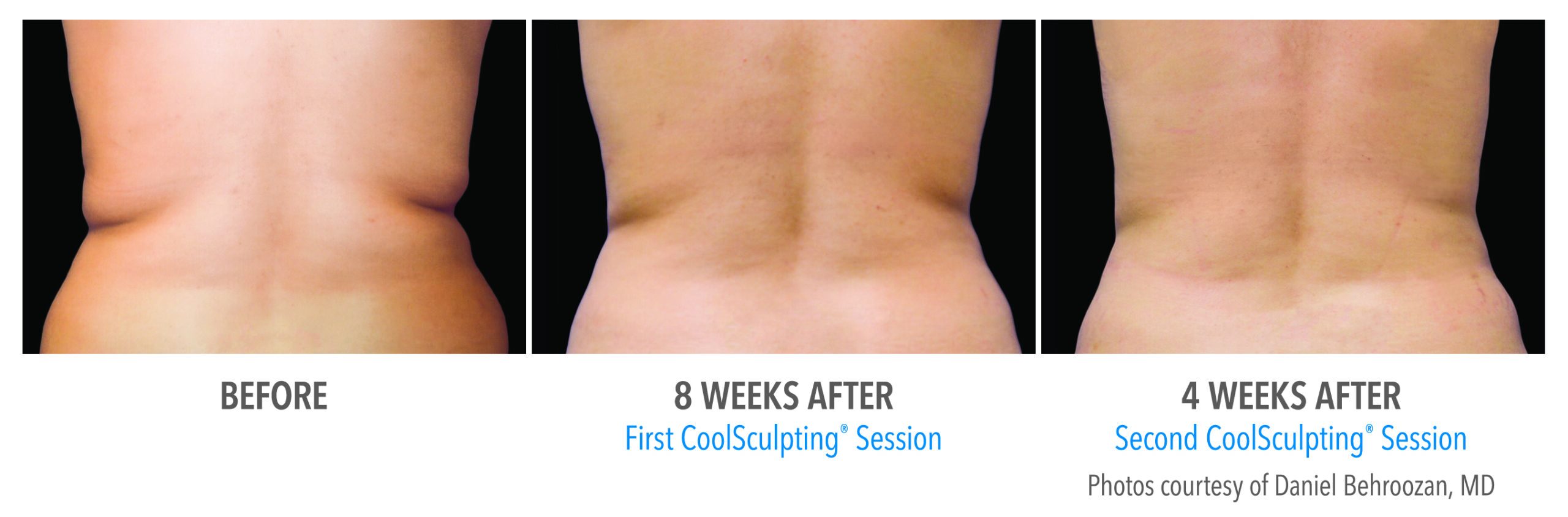 coolsculpting body contouring
