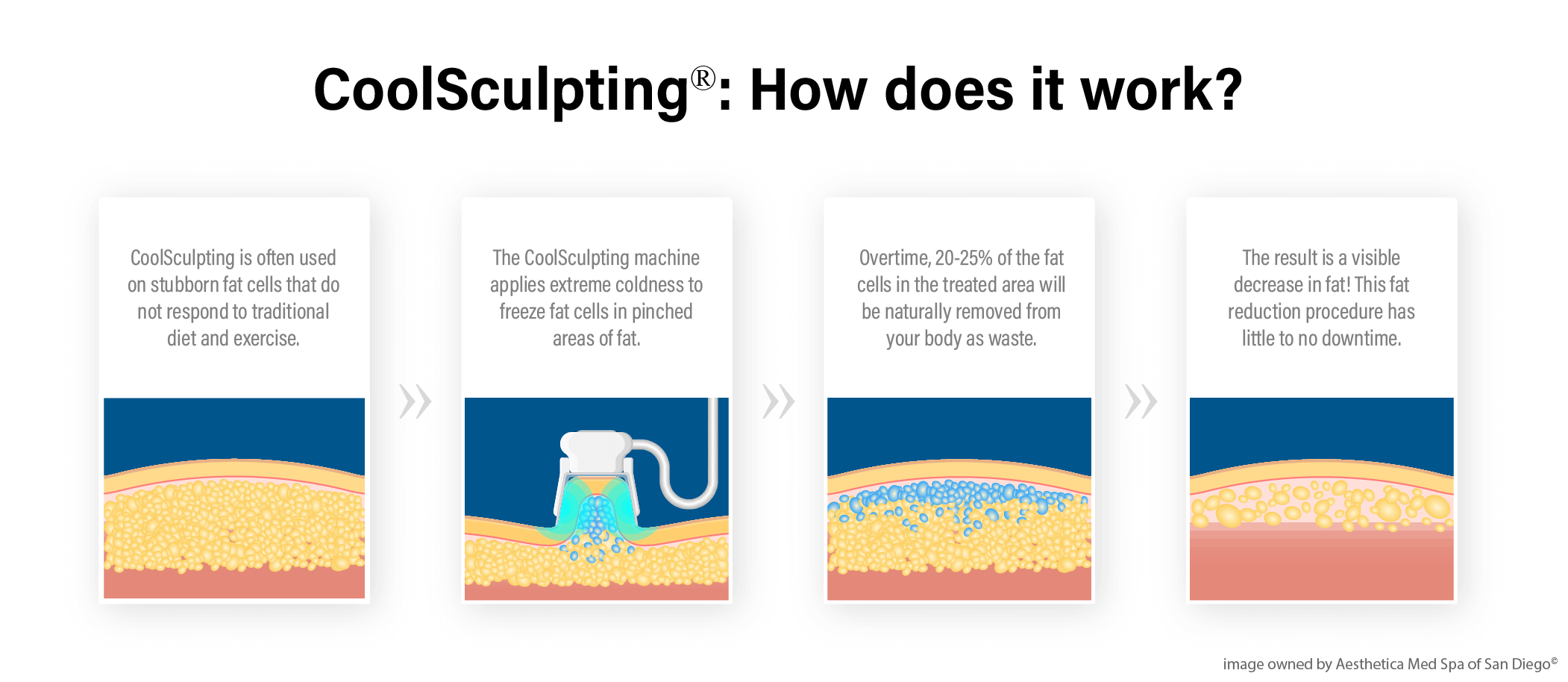 coolsculpting infograph mobile