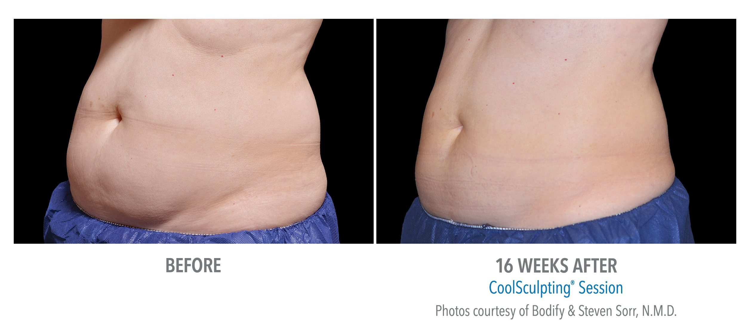 coolsculpting tummy san diego