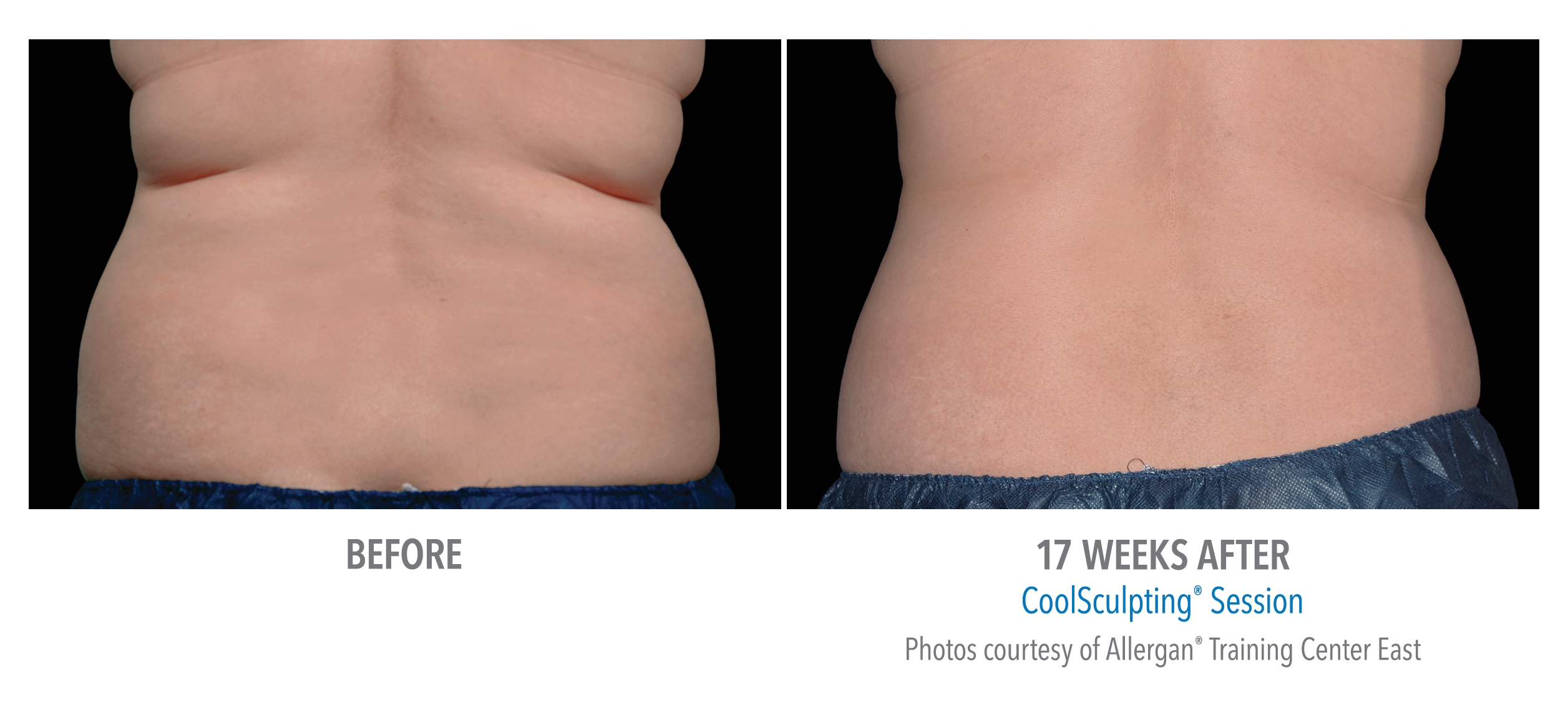 flank fat reduction
