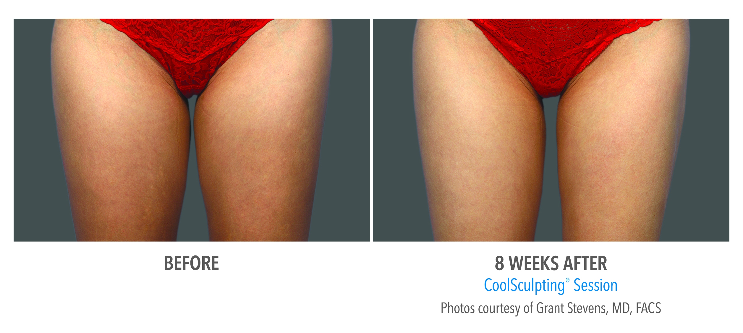 inner thigh gap coolsculpting