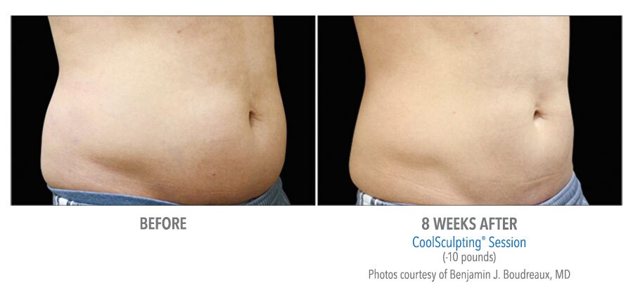 lower abdomen body contouring