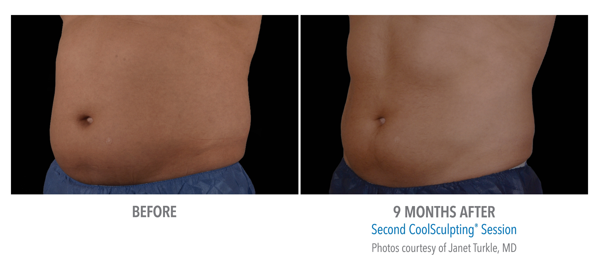 lower abs coolsculpting
