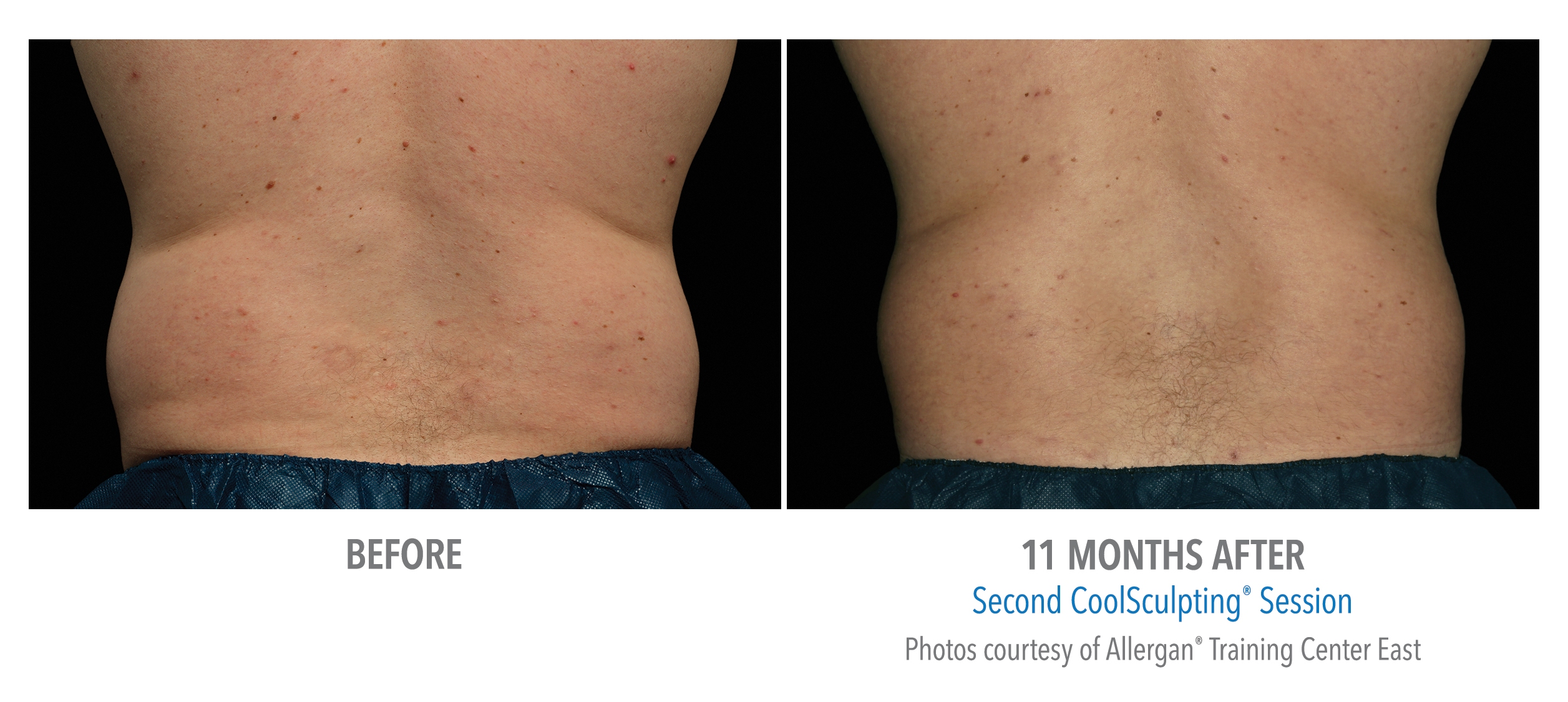 male body contouring