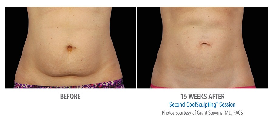 tummy fat reduction coolsculpting