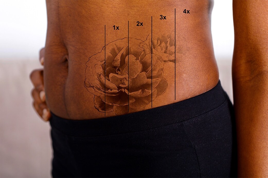 dark skin tattoo removal