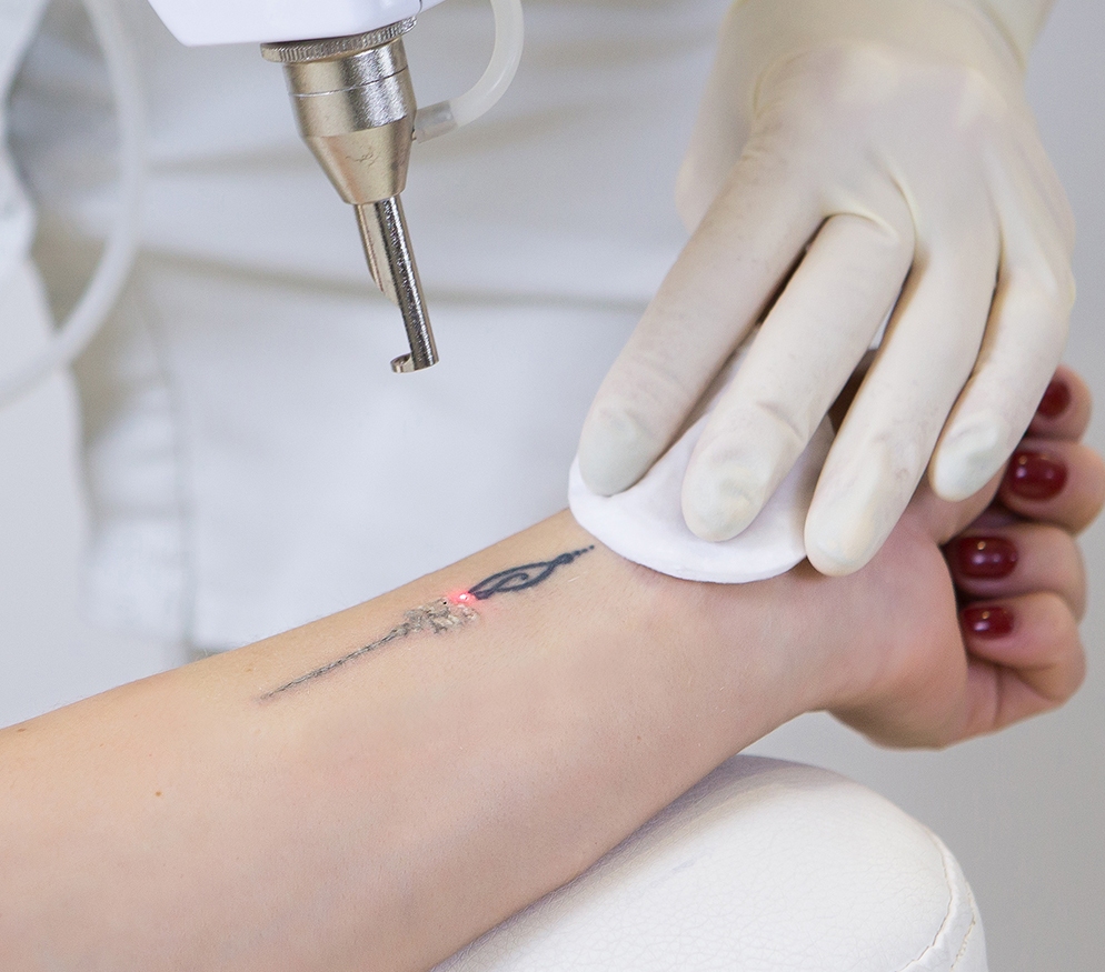 laser tattoo removal