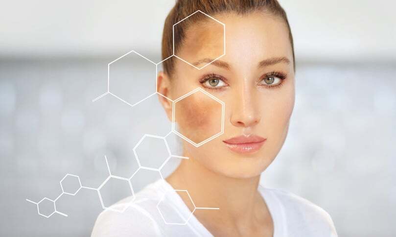 Pico Laser for melasma on face Pico Laser for melasma on face