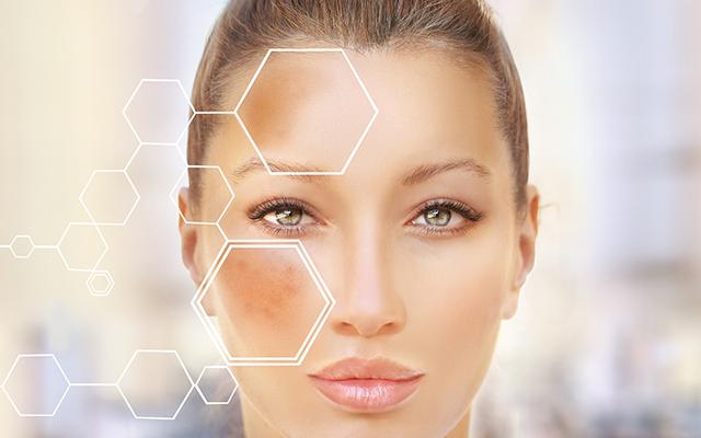 melasma san diego melasma san diego