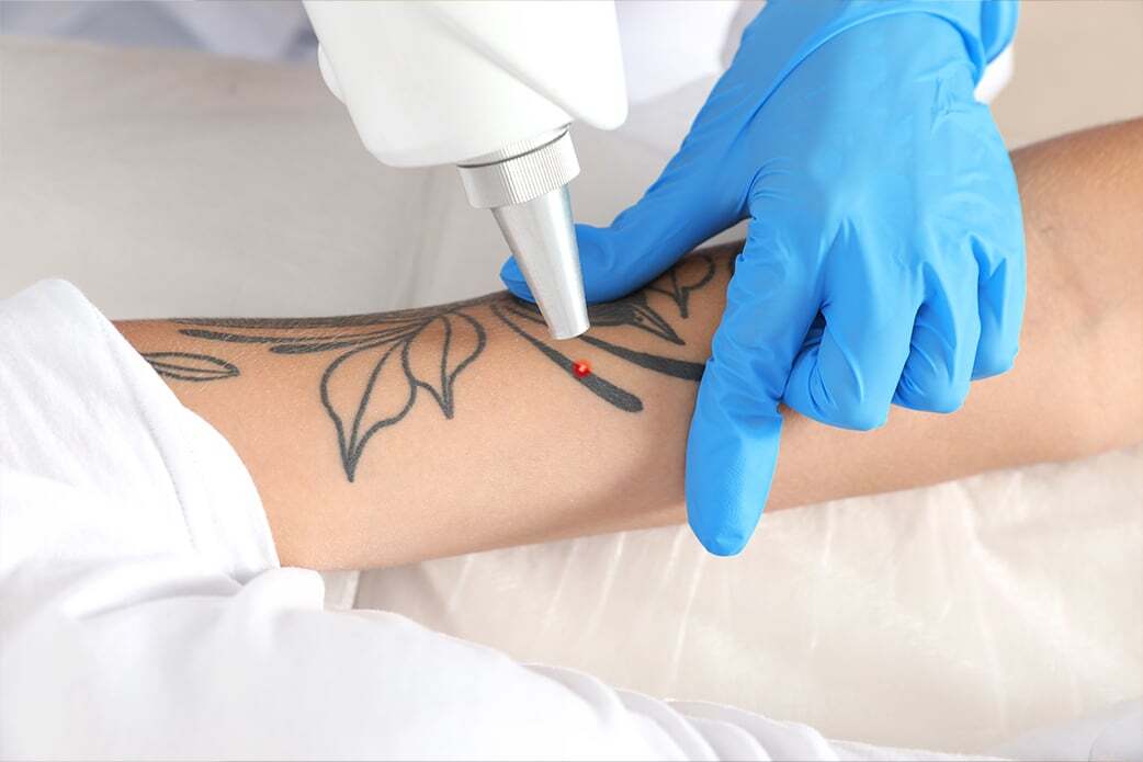 pico laser tattoo removal