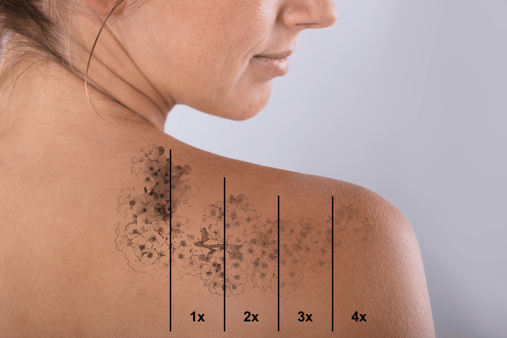 Pico Laser for tattoo removal