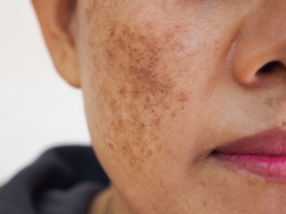 Melasma