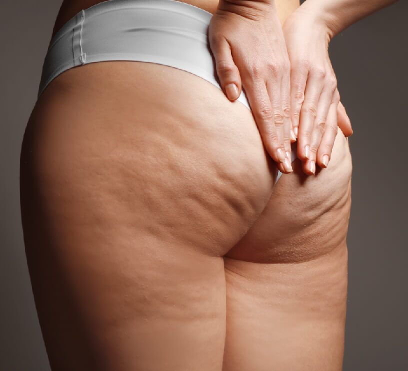 cellulite on butt