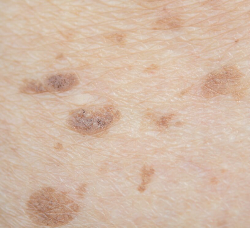 sun/age spots