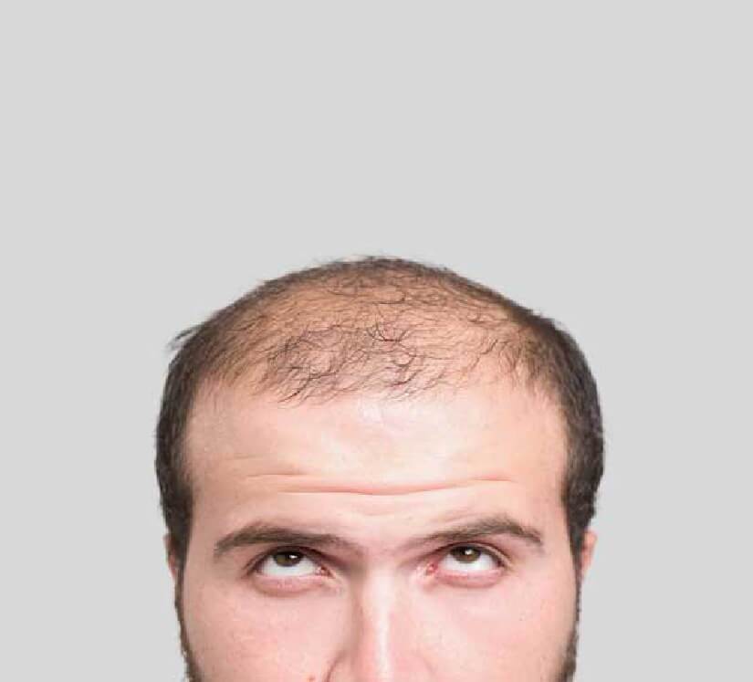 man with balding hair