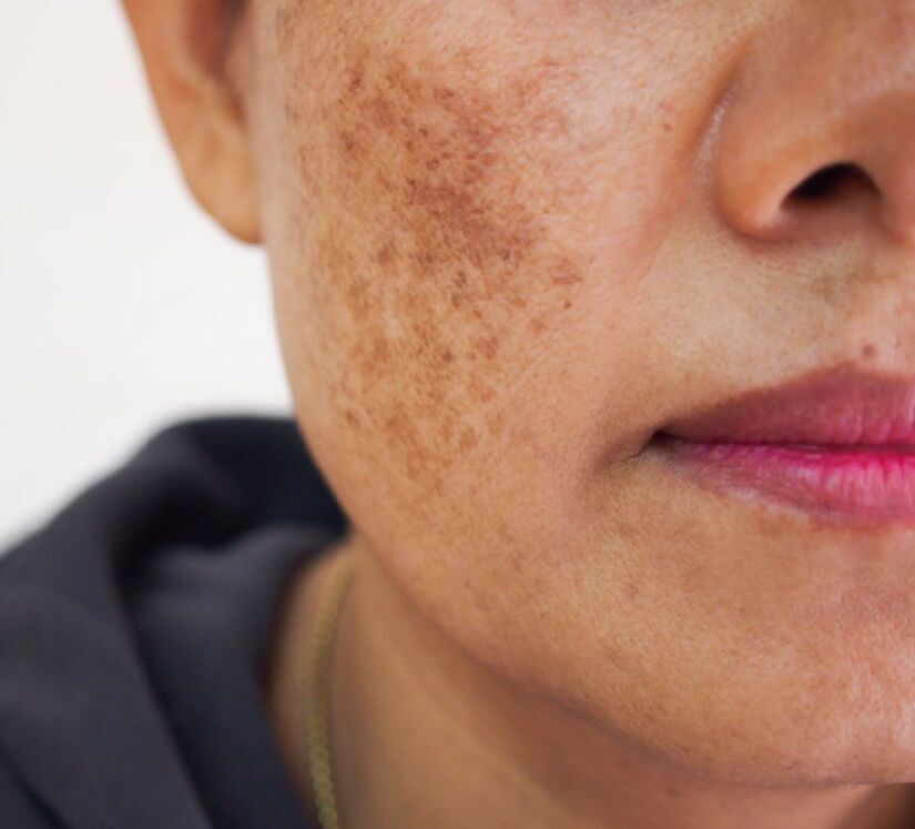 Melasma