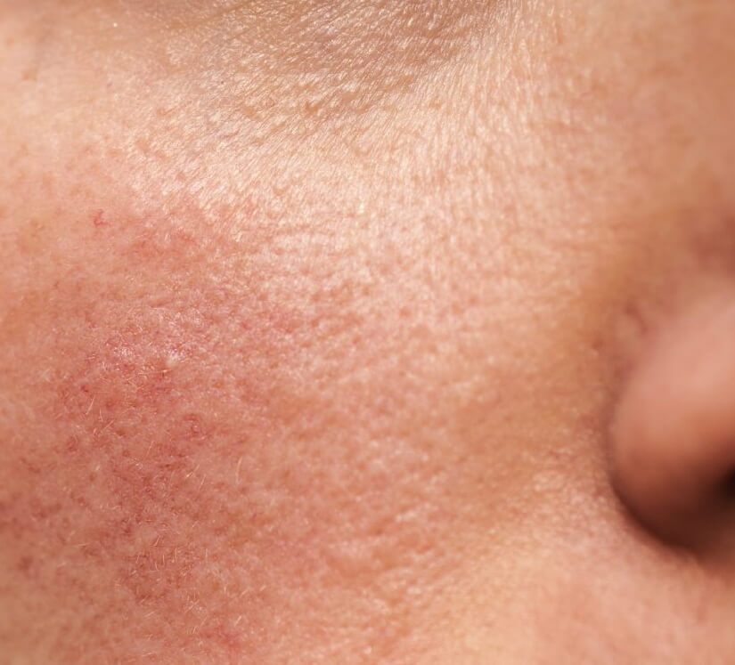 rosacea
