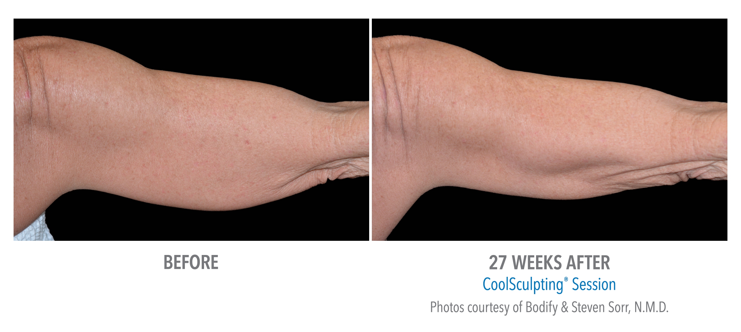 CoolSculpting before after arms