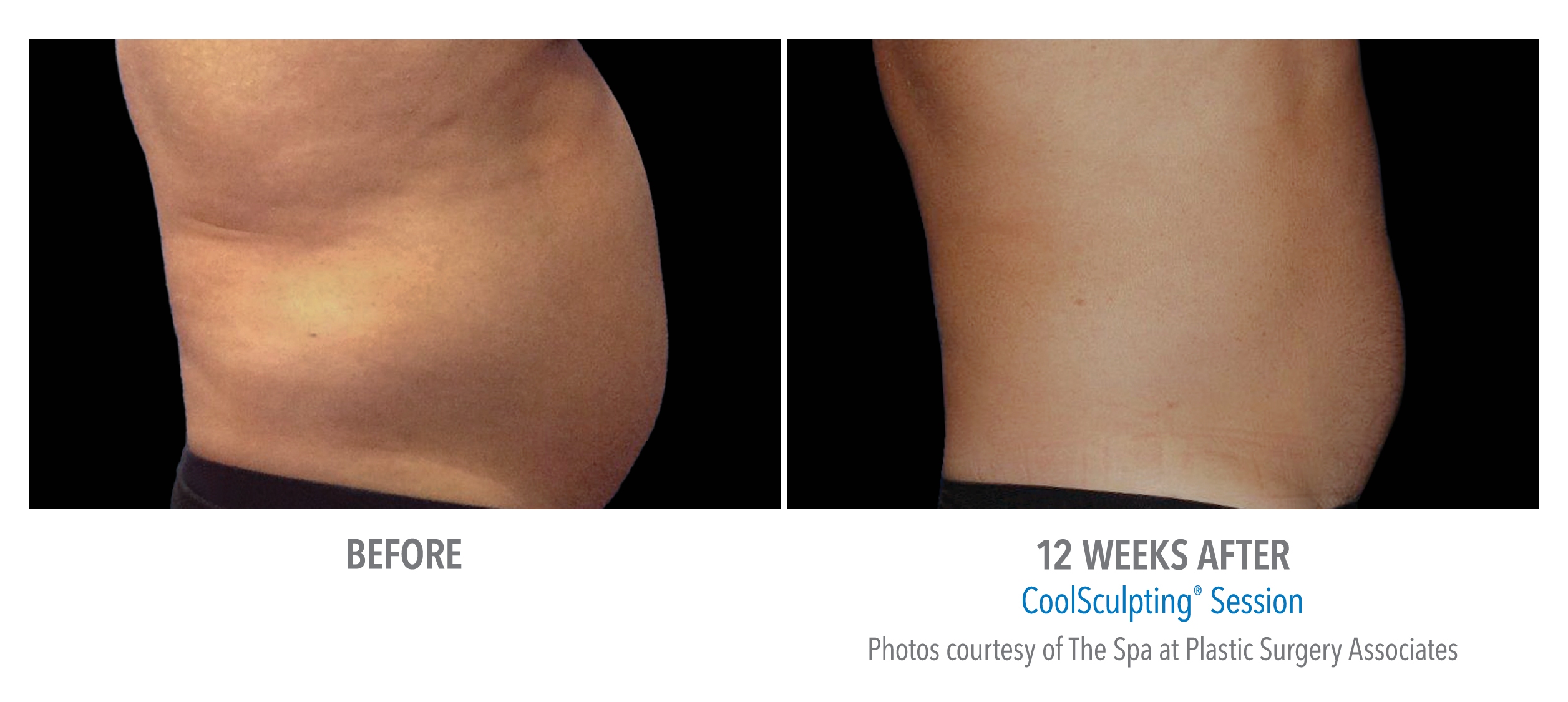 abdomen coolsculpting before after