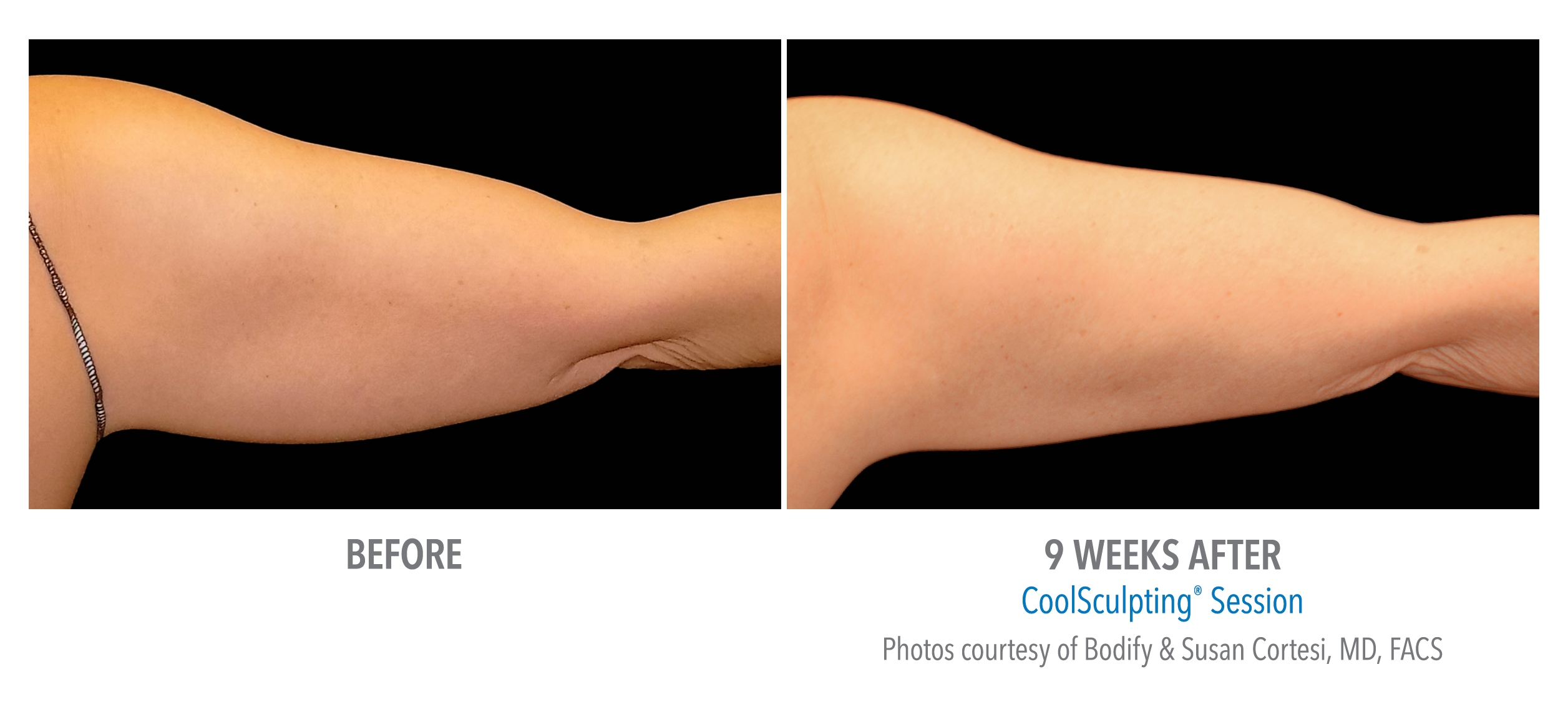 arm coolsculpting before after