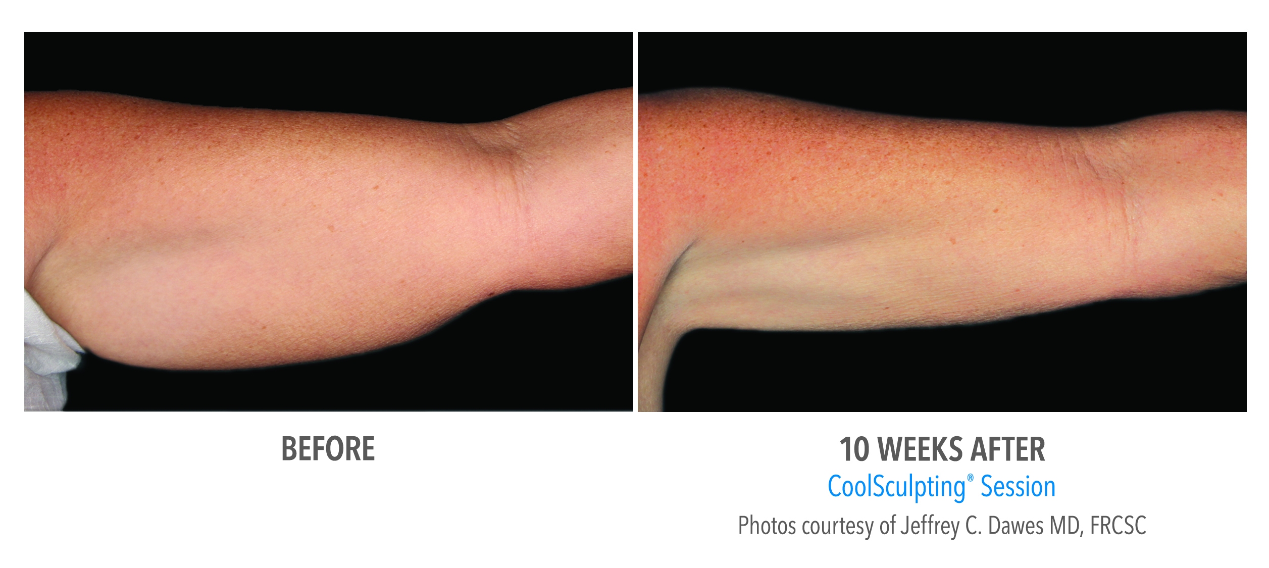 arm fat coolsculpting before after