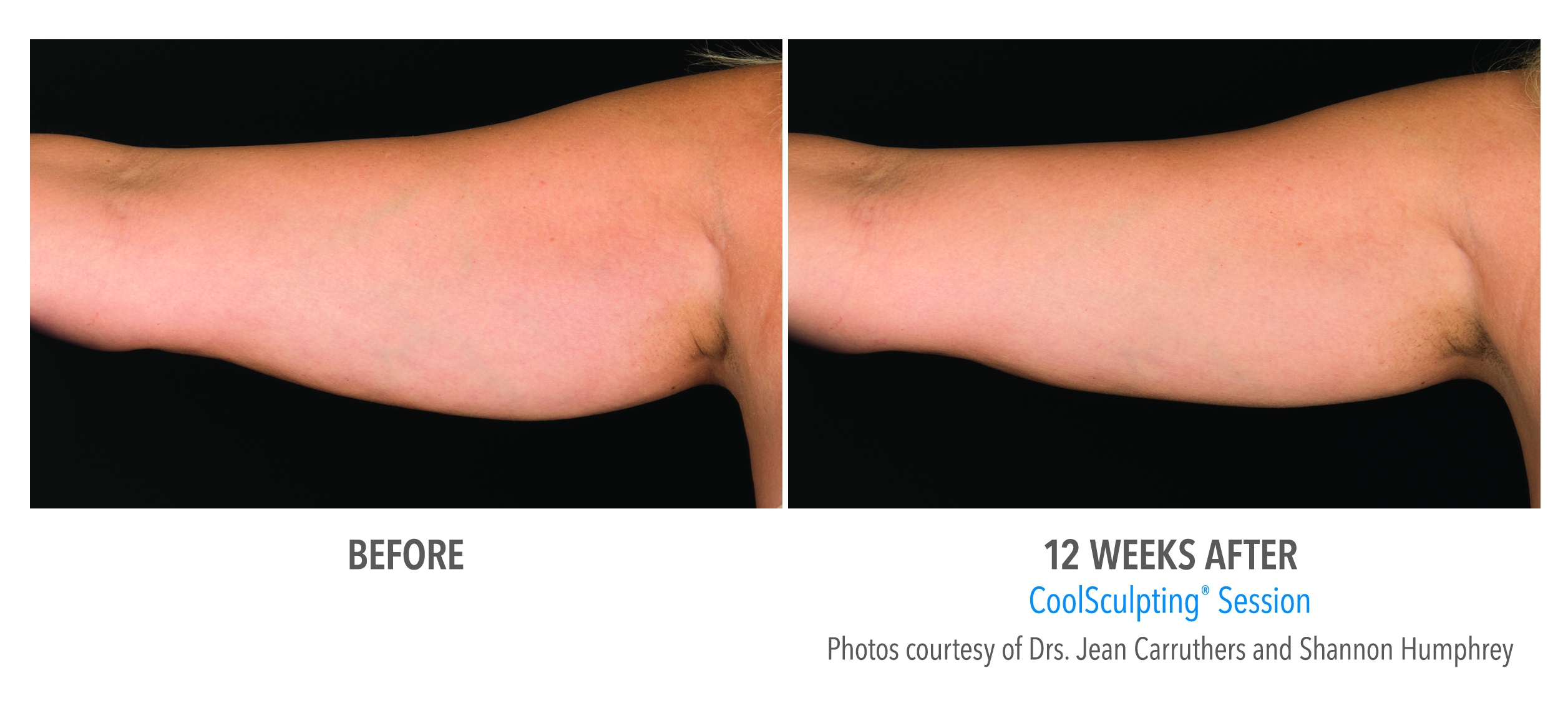 arm fat coolsculpting before afters