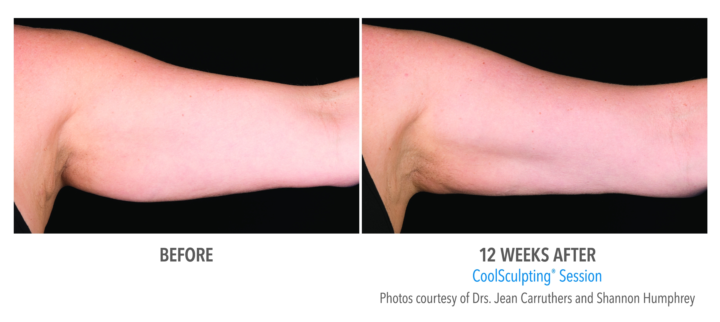 arm fat reduction before after