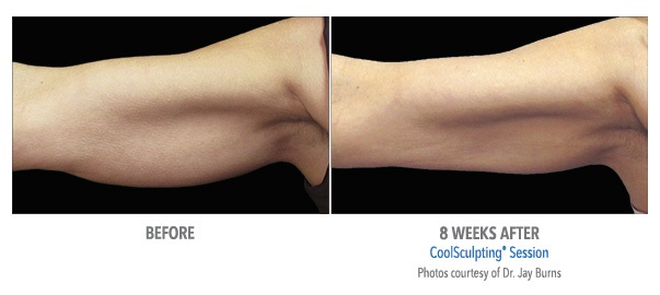 arm reshaping before after coolsculpting