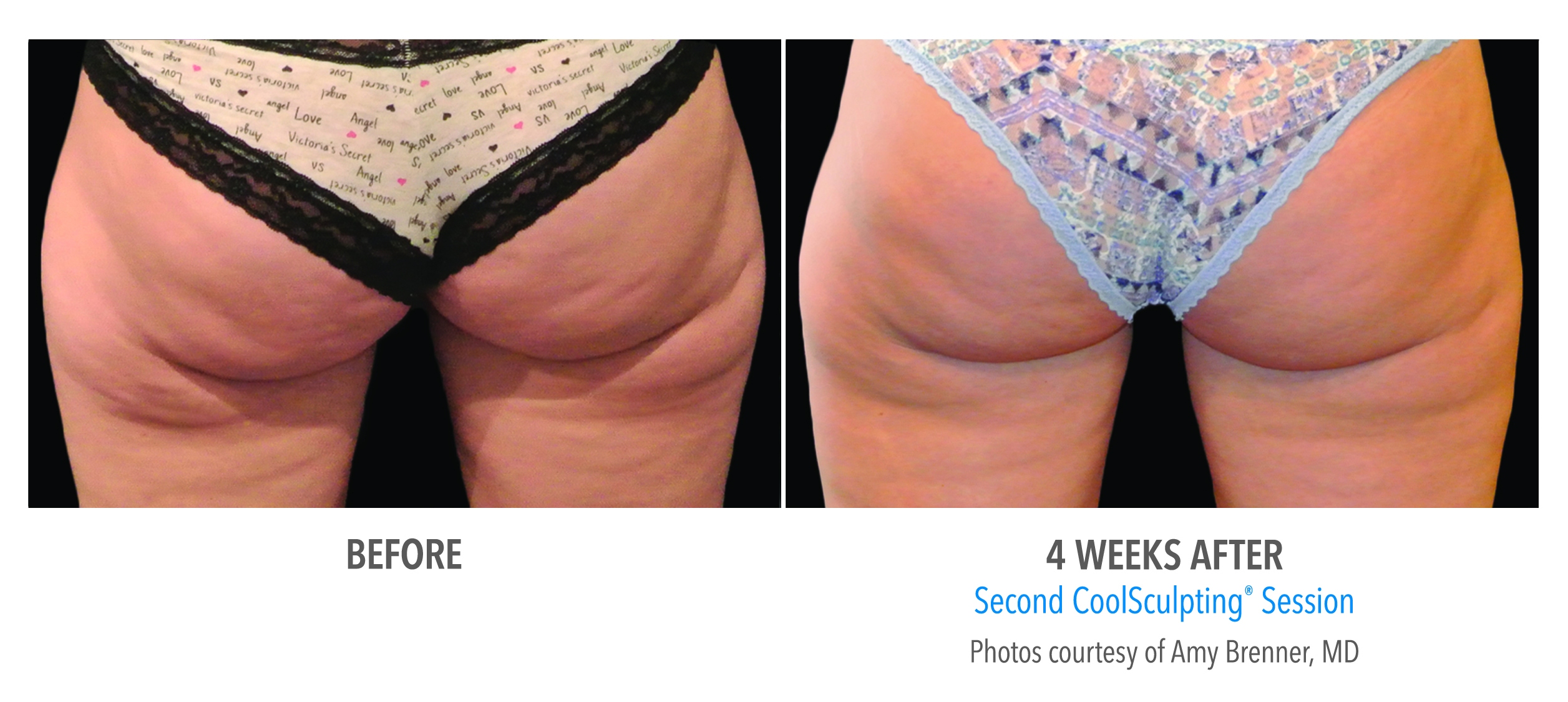 banana rolls coolsculpting before after