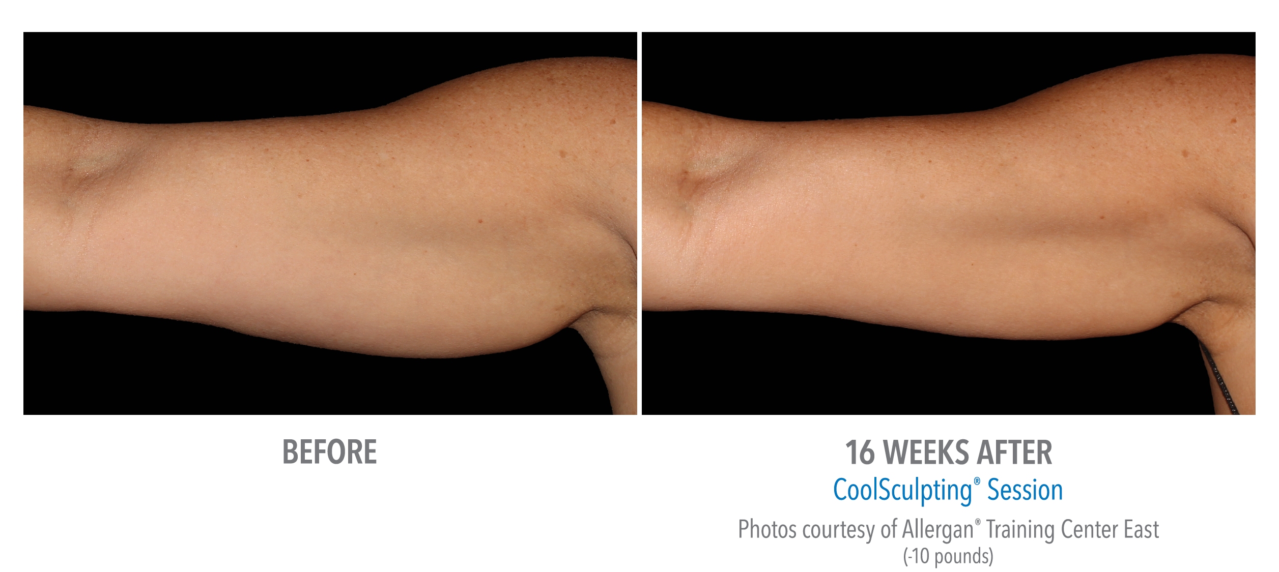 before after coolsculpting arms